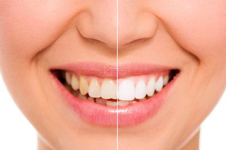 Clínica Dental Errota blanqueamiento dental antes y después 